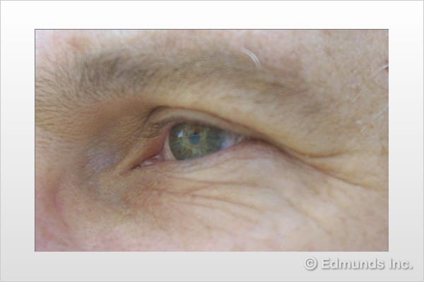 Eye
